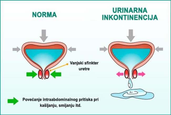 Dijagram poređenja normalne funkcije bešike i urinarne inkontinencije